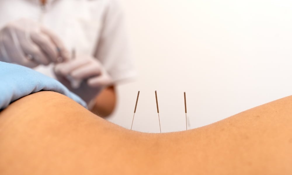 dry needling vs acupuncture